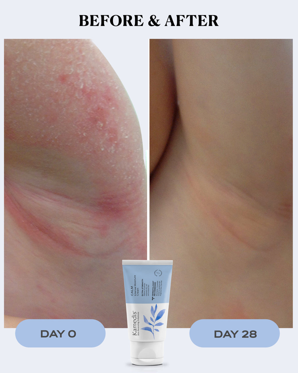 Eczema Therapy Cream | CALM