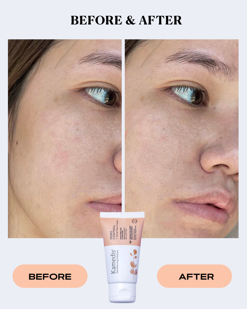 Redness Relief Cream | SEBO CONTROL
