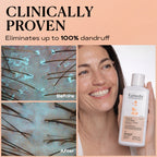 Ultimate Anti Dandruff Kit | SCALP CONTROL