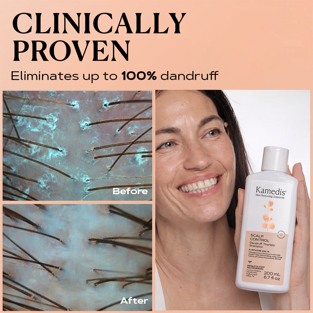 Ultimate Anti Dandruff Kit | SCALP CONTROL